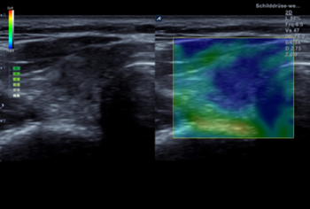 Sonographie, Elastographie